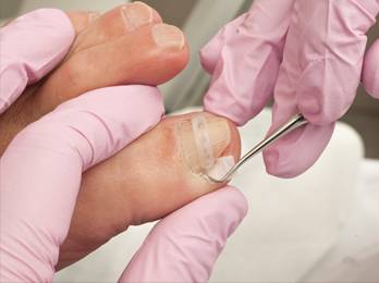 Ingrown Toenails Diagnosis & Treatment in the Wayne County, MI: Detroit (Hamtramck, River Rouge, Dearborn, Melvindale, Highland Park, Grosse Pointe Park, Grosse Pointe, Lincoln Park, Allen Park, Redford Charter Twp) and Lucas County, OH: Toledo (Ottawa Hills, Silica, Holland, Shoreland, Oregon, Harbor View, Maumee) and Wood County, OH: Rossford, Northwood, Walbridge areas