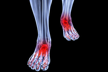 Arthritic foot and ankle care treatment in the Wayne County, MI: Detroit (Hamtramck, River Rouge, Dearborn, Melvindale, Highland Park, Grosse Pointe Park, Grosse Pointe, Lincoln Park, Allen Park, Redford Charter Twp)