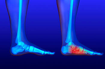 Flat Feet and Fallen Arches Treatment in the Wayne County, MI: Detroit (Hamtramck, River Rouge, Dearborn, Melvindale, Highland Park, Grosse Pointe Park, Grosse Pointe, Lincoln Park, Allen Park, Redford Charter Twp)