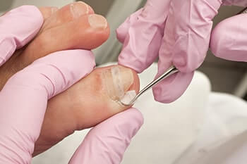 Ingrown toenail specialist in the Wayne County, MI: Detroit (Hamtramck, River Rouge, Dearborn, Melvindale, Highland Park, Grosse Pointe Park, Grosse Pointe, Lincoln Park, Allen Park, Redford Charter Twp) and Lucas County, OH: Toledo (Ottawa Hills, Silica, Holland, Shoreland, Oregon, Harbor View, Maumee) and Wood County, OH: Rossford, Northwood, Walbridge areas