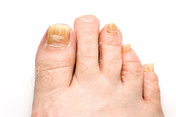 Toenail fungus treatment and restoration in the Wayne County, MI: Detroit (Hamtramck, River Rouge, Dearborn, Melvindale, Highland Park, Grosse Pointe Park, Grosse Pointe, Lincoln Park, Allen Park, Redford Charter Twp) and Lucas County, OH: Toledo (Ottawa Hills, Silica, Holland, Shoreland, Oregon, Harbor View, Maumee) and Wood County, OH: Rossford, Northwood, Walbridge areas