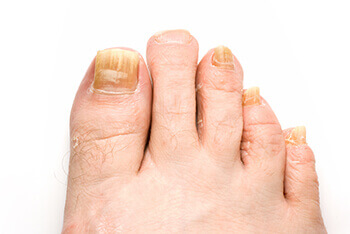 Toenail fungus treatment and restoration in the Wayne County, MI: Detroit (Hamtramck, River Rouge, Dearborn, Melvindale, Highland Park, Grosse Pointe Park, Grosse Pointe, Lincoln Park, Allen Park, Redford Charter Twp)