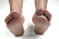 Rheumatoid Arthritis and the Feet