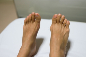Bunions and Simple Exercises for Relief