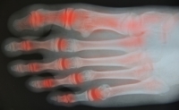 Signs of Rheumatoid Arthritis