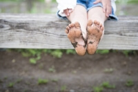 Juvenile Plantar Dermatosis