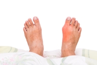 Bunions and Their Impact on Foot Health